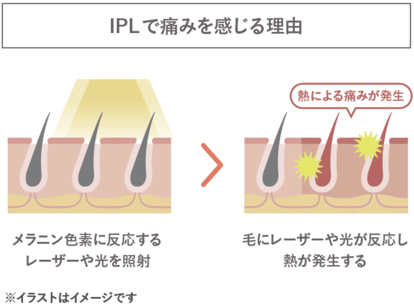 IPLで痛みを感じる理由